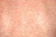 小孩生病後出現這種皮疹，是疾病原因，還是抗生素治療導致的過敏？