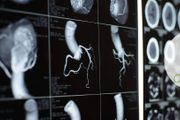 冠狀動脈CT和冠狀動脈造影的區別是什麼？