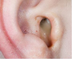 鼓膜穿孔後，可見耳道流膿