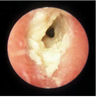耳道溼疹、感染+分泌物痂塊堆積