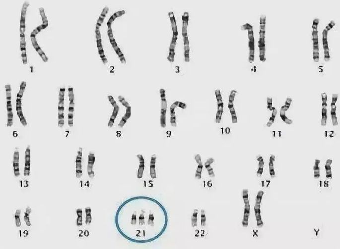 例如，唐氏綜合徵便是第21號染色體異常所致