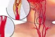 頸動脈內中膜增厚與頸動脈斑塊是什麼關係？
