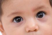 小孩黑眼圈（眼皮下發黑）是為什麼呢？