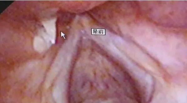 患者喉腔中的魚刺