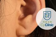 耳褶心徵：耳褶與心血管疾病有關嗎？