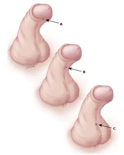 根據尿道口的位置不同分為四型[2]