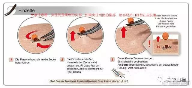 德國醫生畫的取蜱蟲示意圖
